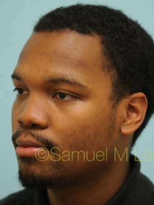 Rhinoplasty-Nose Job
