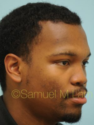 Rhinoplasty-Nose Job
