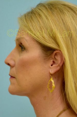 Primary Facial Fat Transfer