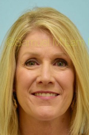 Primary Facial Fat Transfer