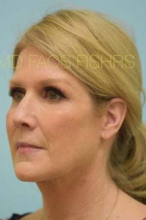 Primary Facial Fat Transfer