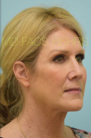 Primary Facial Fat Transfer