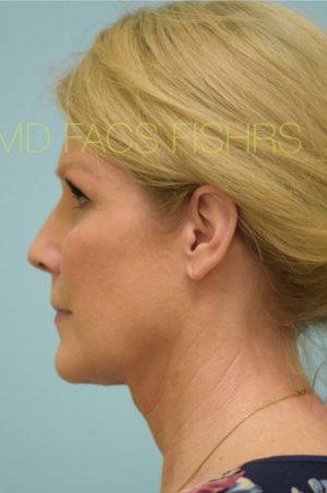 Primary Facial Fat Transfer
