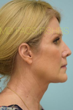 Primary Facial Fat Transfer