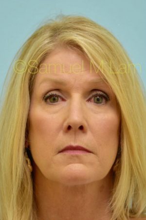 Primary Facial Fat Transfer