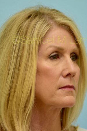 Primary Facial Fat Transfer