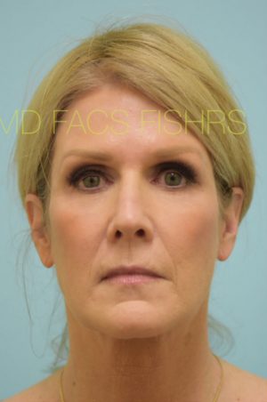 Primary Facial Fat Transfer