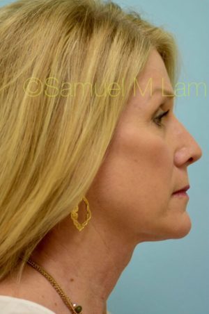 Primary Facial Fat Transfer