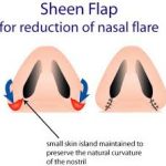 Rethinking the Alar-Base Reduction: When, How, and Why to Reduce the Nostrils in Rhinoplasty