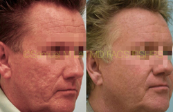 Acne Scarring Before and After