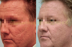 Acne Scarring Before and After
