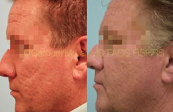 Acne Scarring Before and After