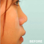 Image of a Asian Cosmetic Surgery patient