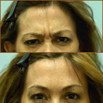 Fillers and Injectables Video Testimonials
