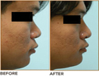 Asian Rhinoplasty Before and After Plano Tx
