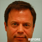 Image of a Botox patient