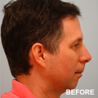 Image of a Chin Augmentation patient
