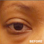 Image of a Eyelid Lift patient
