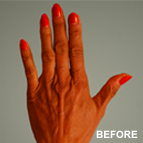 Image of a Fat Grafting patient