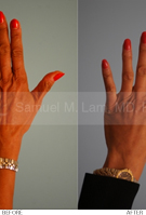 hand fat grafting