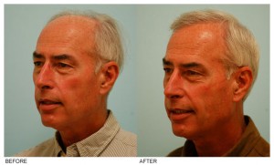 Hair Transplant Dallas, Hair Restoration Plano, TX Hair Transplant Dallas, Hair Restoration Plano, TX