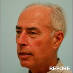 Image of a Hair Transplant patient