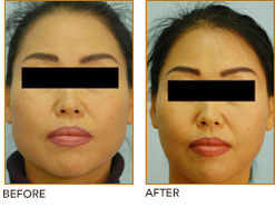 jaw reduction