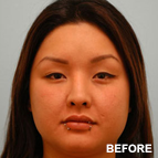 Image of a Jaw Reduction Surgery patient