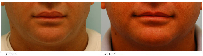 Lip Procedures