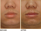 Lip Reduction Before and After Plano Tx