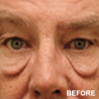 Image of a Malar Mound Reduction patient