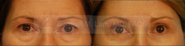 Brow Lift Results Dallas