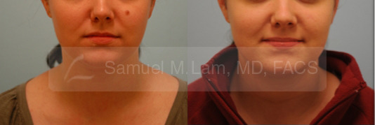 Skin Lesions / Mole Removal Photos