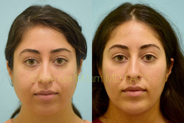 Dallas Botox Before and After Photos - Plano Plastic Surgery Photo