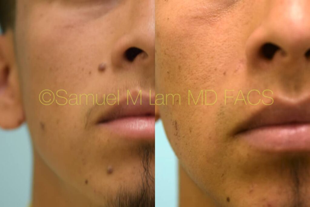 Dallas Mole Removal and Facial Excisions Before and After Photos