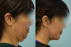 Facelift/Mini Facelift Before & After Photos Dallas and Plano, TX