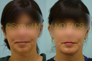 Facelift/Mini Facelift Before & After Photos Dallas and Plano, TX