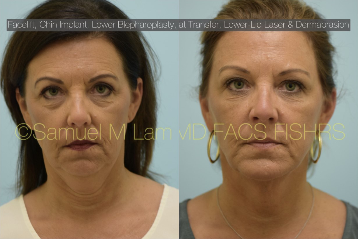 Facial Rejuvenation Photos