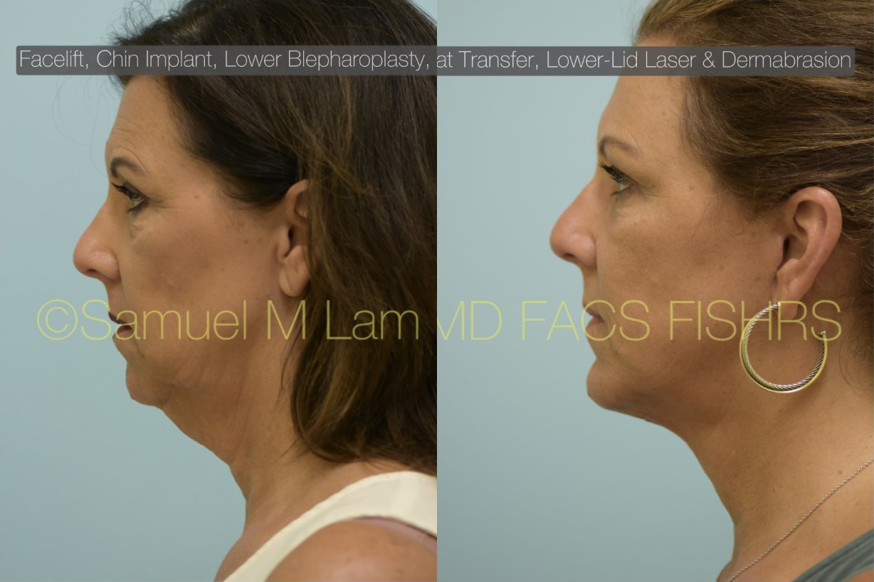 Facial Rejuvenation Photos