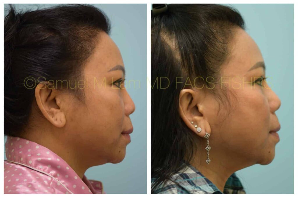 Dallas Revision/Corrective Rhinoplasty Before and After Photos Plano