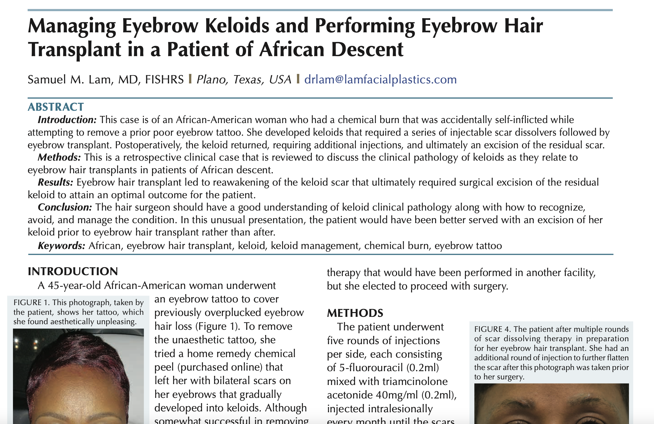Dr. Samuel M. Lam featured in International Society of Hair Restoration Surgery (ISHRS)
