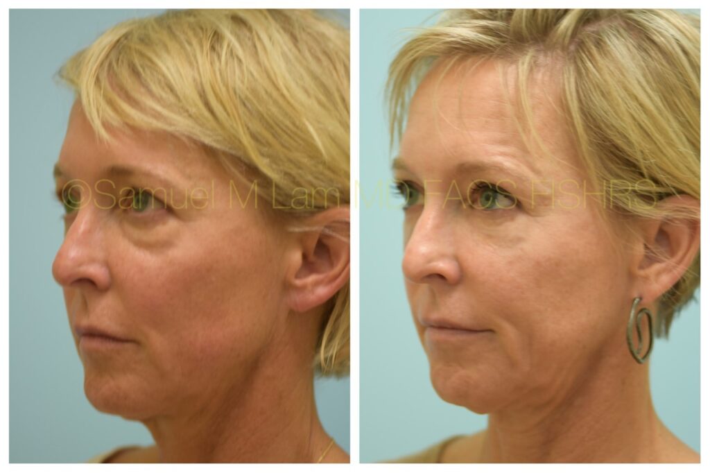 Dallas Corrective Facial Fat Transfer Before and After Photos Plano