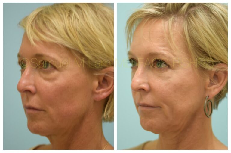 Dallas Corrective Facial Fat Transfer Before and After Photos Plano
