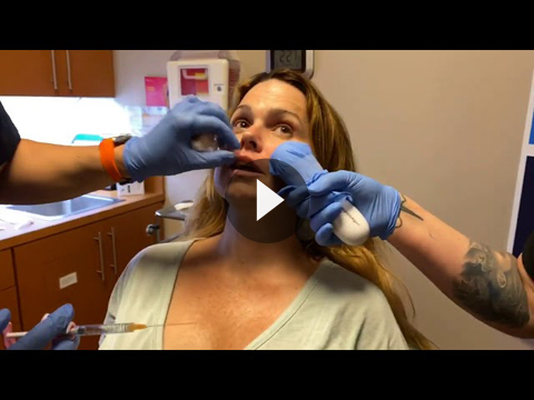 Botox Jaw Reduction Videos