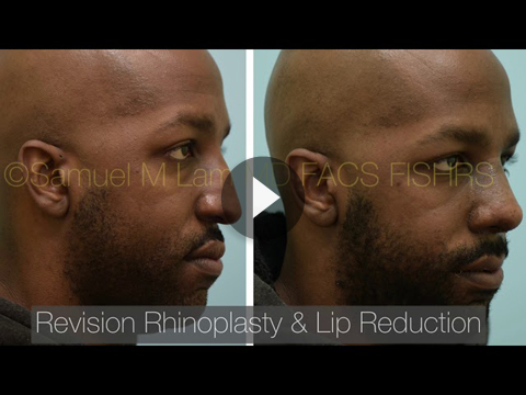 Male Rhinoplasty Videos