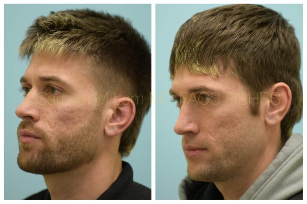 Dallas Acne Scarring Correction Before and After Photos Plano Plastic