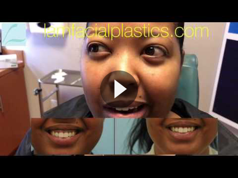 Botox for Gummy Smile Videos