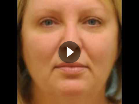 Botox Jaw Reduction Videos