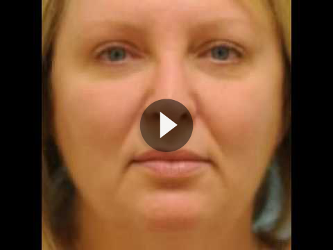 Botox Jaw Reduction Videos