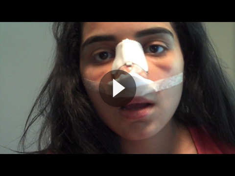 Hispanic Rhinoplasty Videos